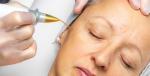 Uklanjanje bradavice, keratoze ili fibroma inovativnim tretmanom PLASMA PEN u Bio+klinik kozmetičkom salonu